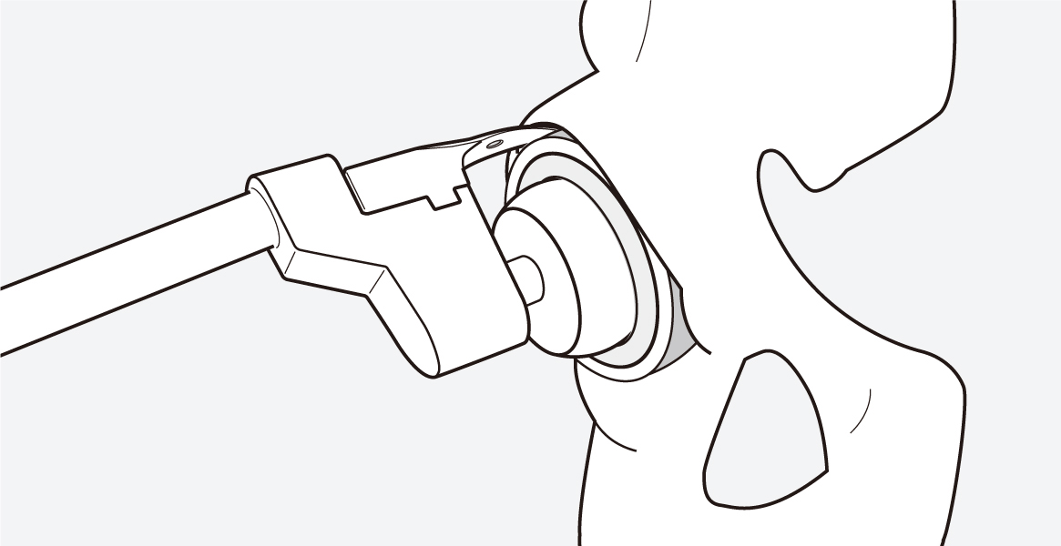 Cup Revision Using Dedicated Rotational Blade